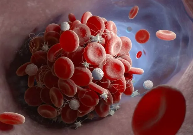 O que muda no tratamento da Nefrite Lúpica quando tem SAF associada?