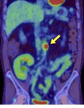 Aortite em um transplantado renal: raro, mas com implicações importantes