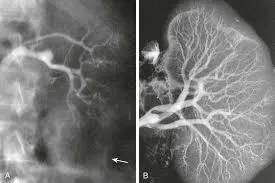 Síndrome hepatorrenal: Por que ainda erramos tanto no diagnóstico e, principalmente, no tratamento?