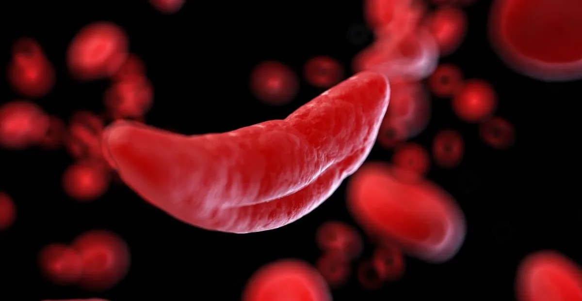 Manejo da Doença Renal na Anemia Falciforme