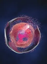 IRA por Síndrome de Lise Tumoral Espontânea