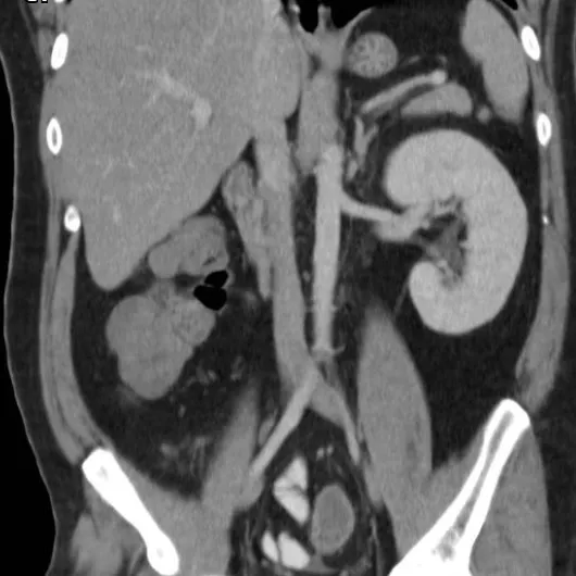 Manejo de pacientes com rim único: que cuidados devemos tomar ao orientar um o paciente? 