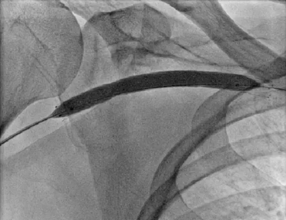 Angioplastia com ou sem stent na estenose de FAV?