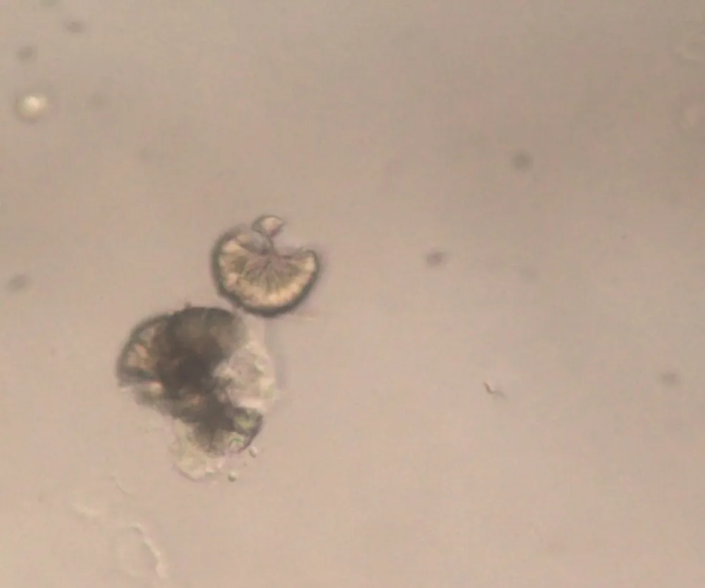 Cristalúria induzida por sulfadiazina