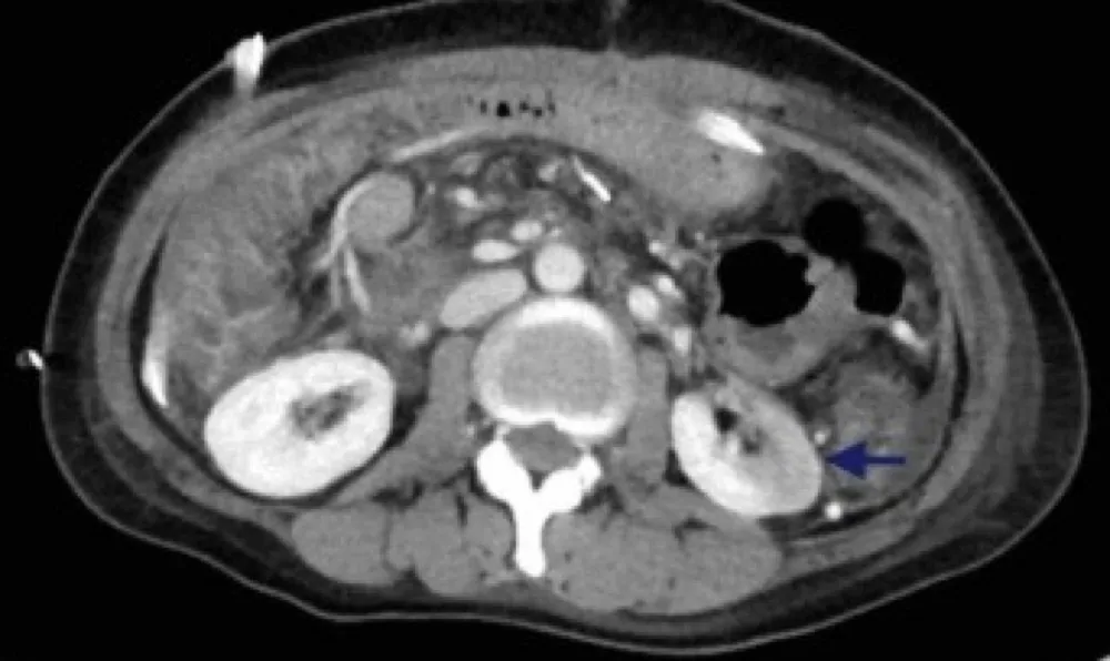 Hipertensão autolimitada devido a infarto renal