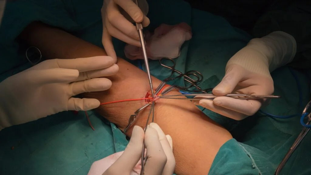 A eficácia da apixabana na prevenção de trombose de FAV pós trombectomia