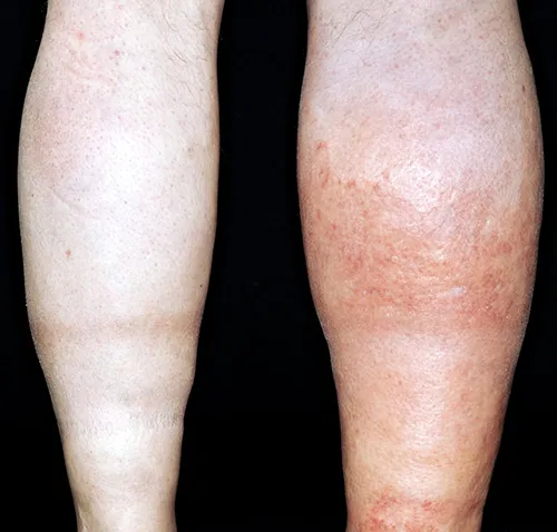 Trombose do cateter associado à TVP, o que fazer?