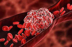 Risco de Trombose na Nefropatia Membranosa Primária: O que há de novo?