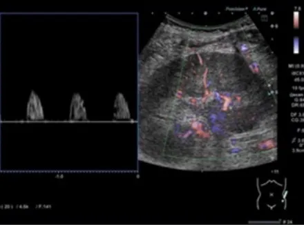 Hematúria e Lesão Renal Aguda em Paciente com Câncer Renal: Quando Pensar em Trombose da Veia Renal?