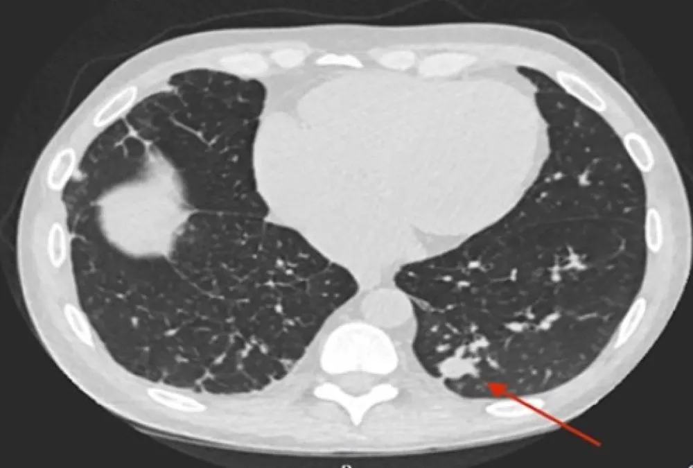 Febre, nódulo pulmonar e granuloma em um paciente transplantado renal
