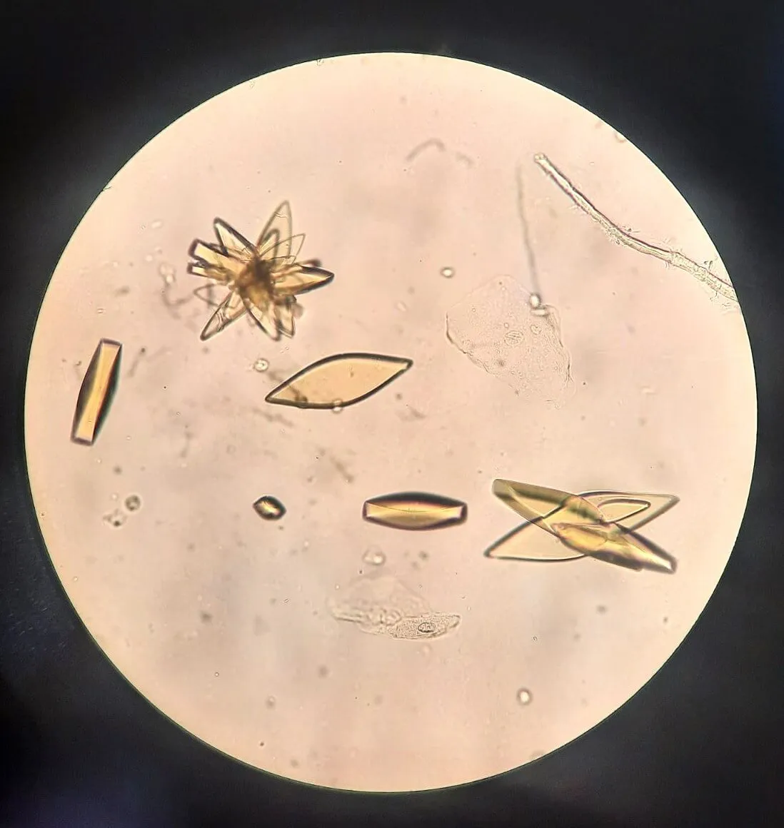 Cálculos de ácido úrico: foco na alcalinização urinária e abordagem prática