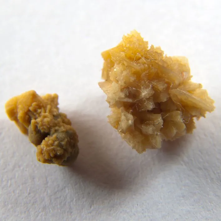 Ingestão de Gordura e Nefrolitíase por Ácido úrico 