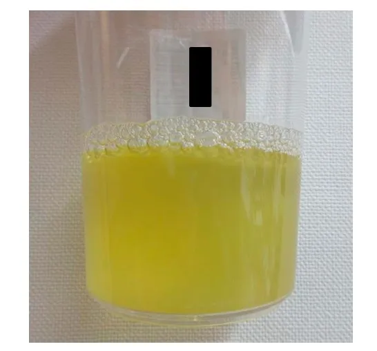 Pseudo-IRA em uma paciente com Ascite