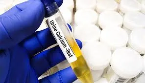 Hipercalciúria: como investigar de forma prática no consultório nefrológico