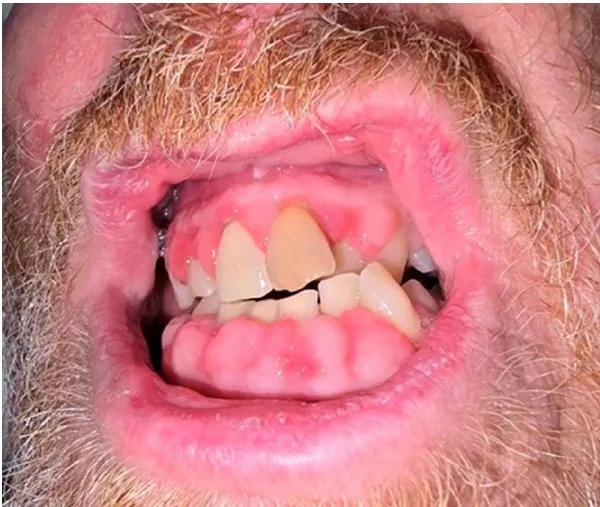 Inibidores de calcineurina e hiperplasia gengival: o que esse caso pode ensinar?