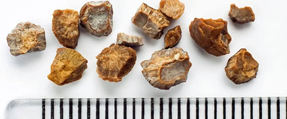 Investigação de calculo renal na prática